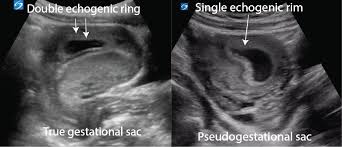 Gestational sac vs pseudosac